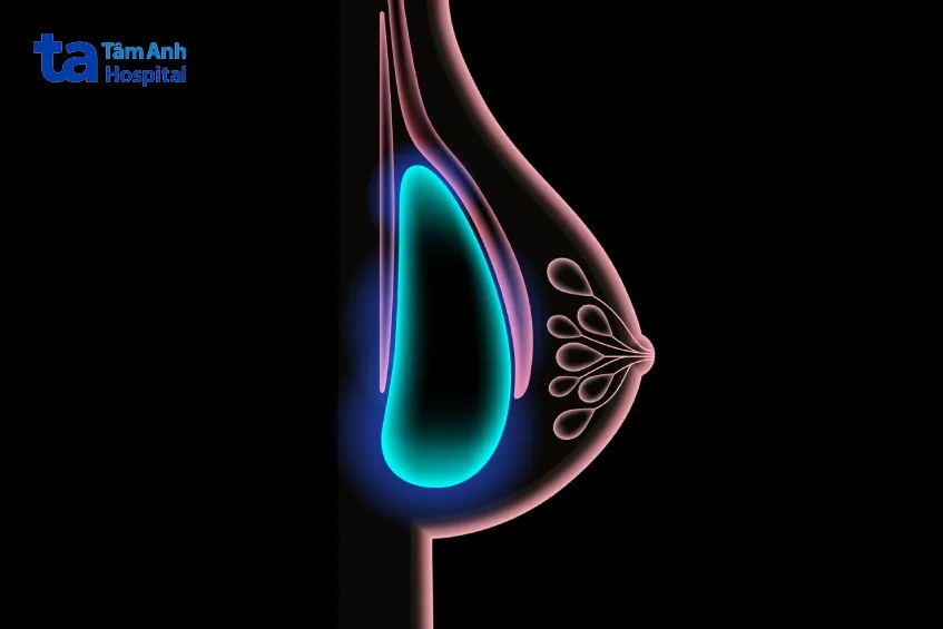 Nâng ngực vẫn có thể tầm soát ung thư vú được nhưng đòi hỏi phải có phương tiện và kỹ thuật khó hơn, giúp làm hồng nhũ hoa